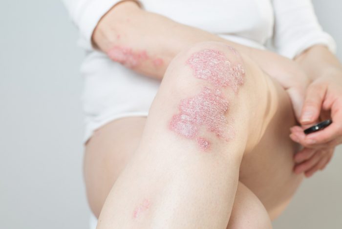 psoriasis-causas-sintomas-y-tratamientos